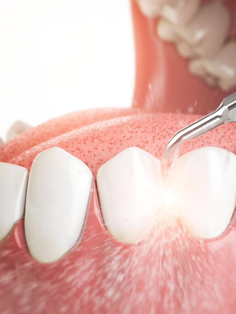 Periimplantitis Behandlung in Leipzig