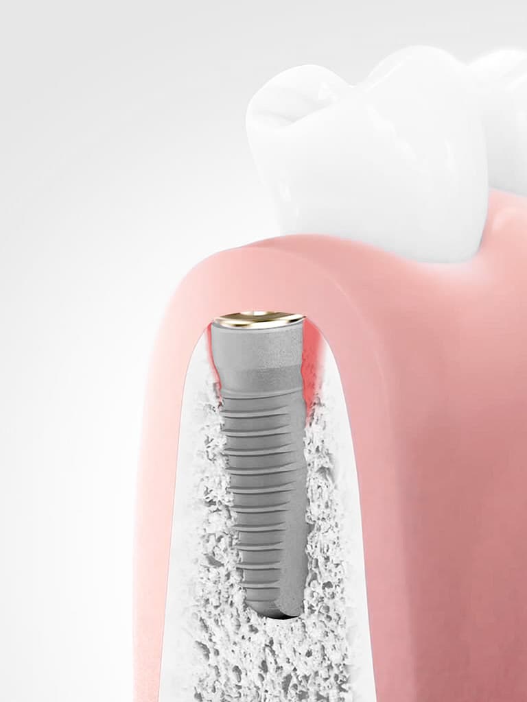 Periimplantitis