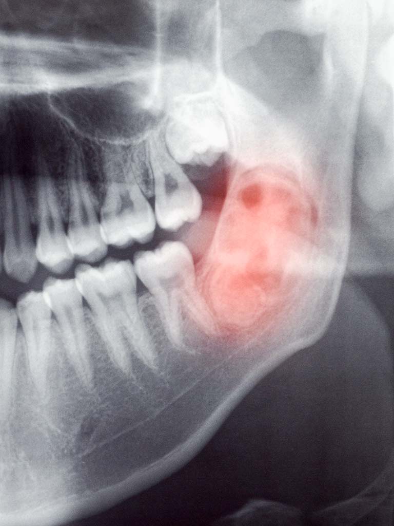 Tumor Röntgen-Aufnahme