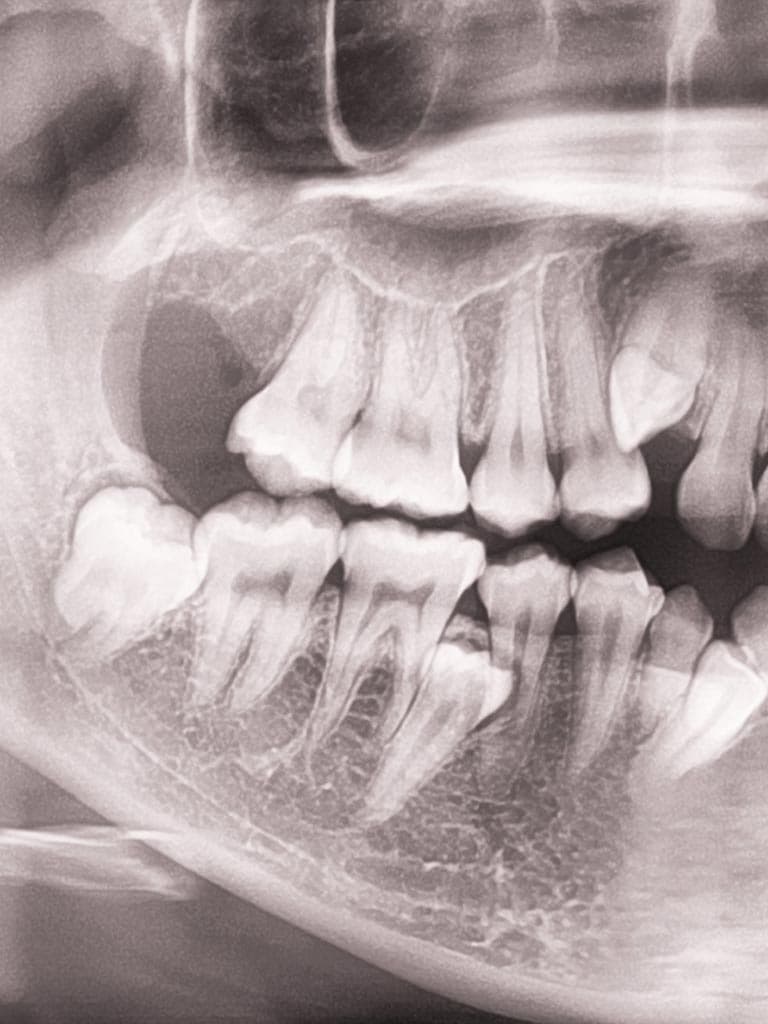 Verlagerte Zähne Röntgenbild