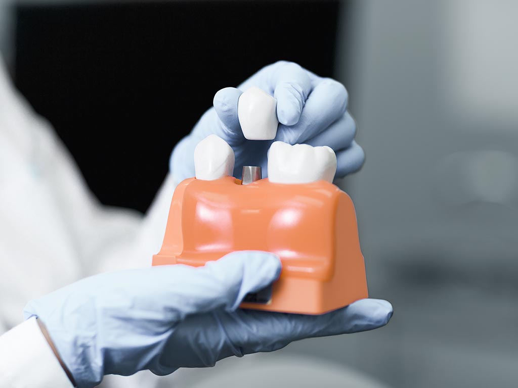 Versorgung der Implantate
